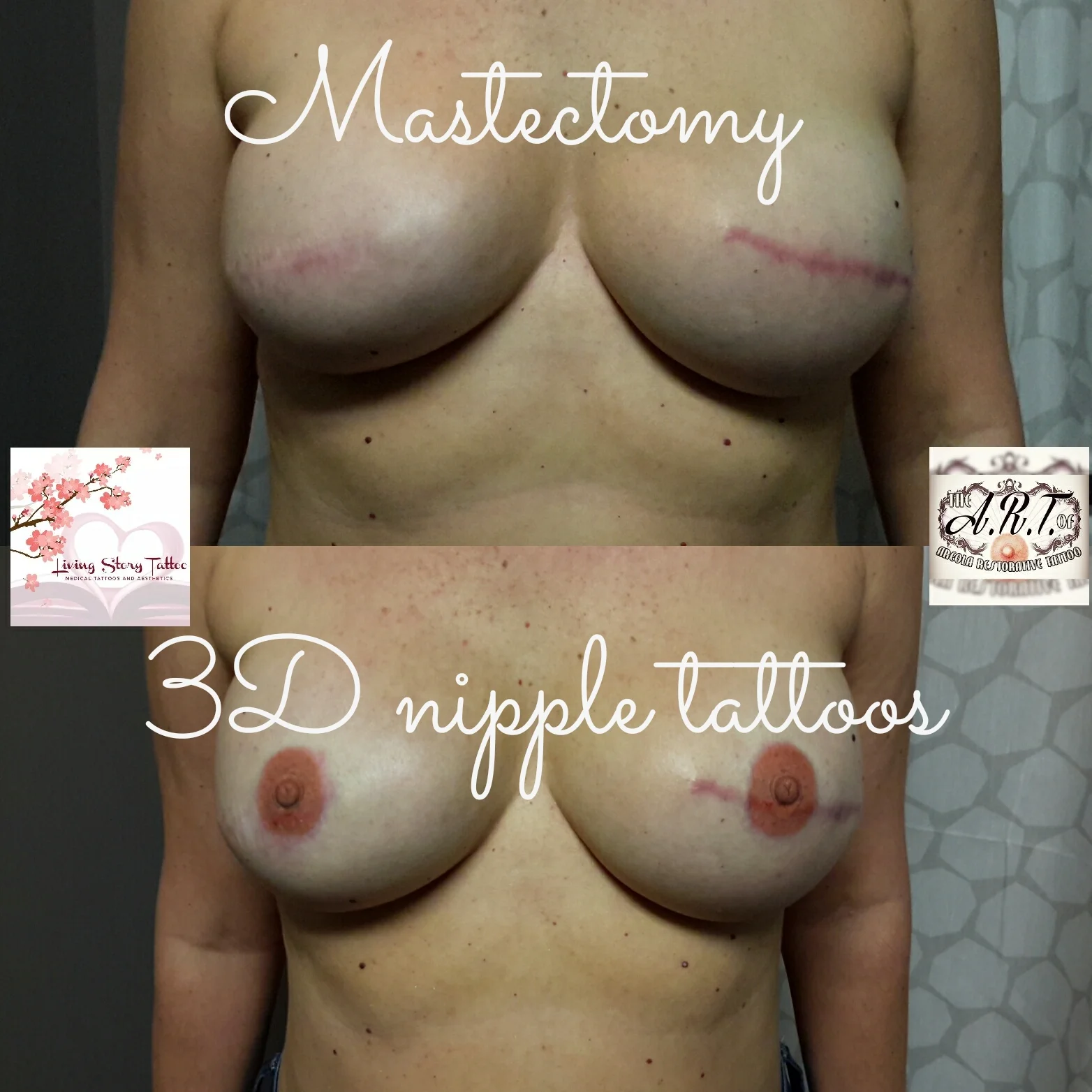 Bilateral Implant Reconstruction