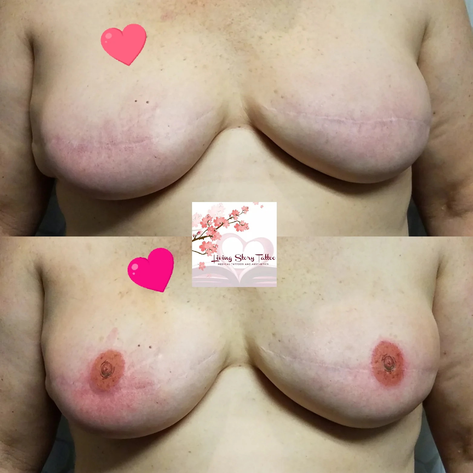 Bilateral Implant Tattoo