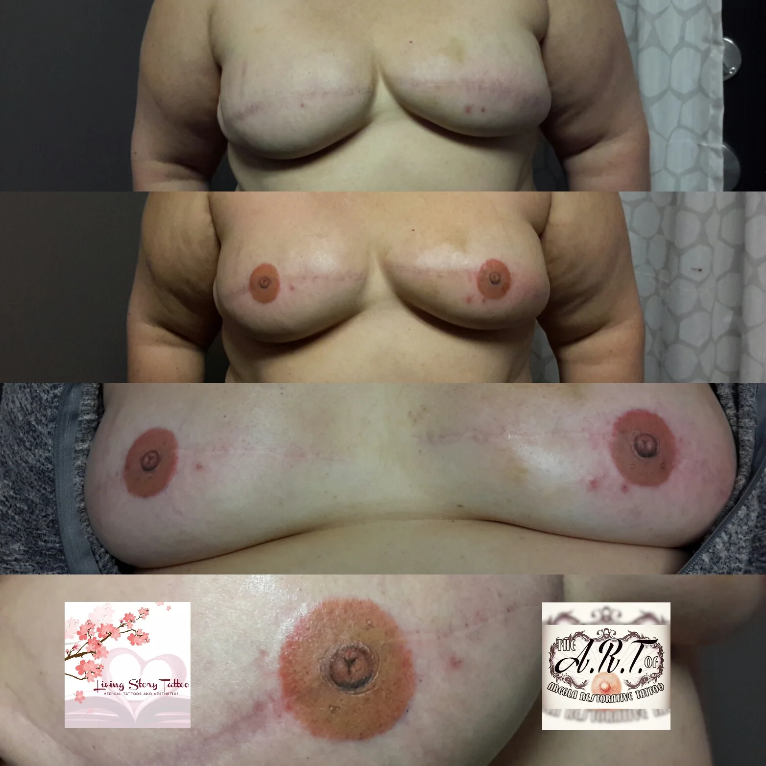 Bilateral Implant 3D Tattoo