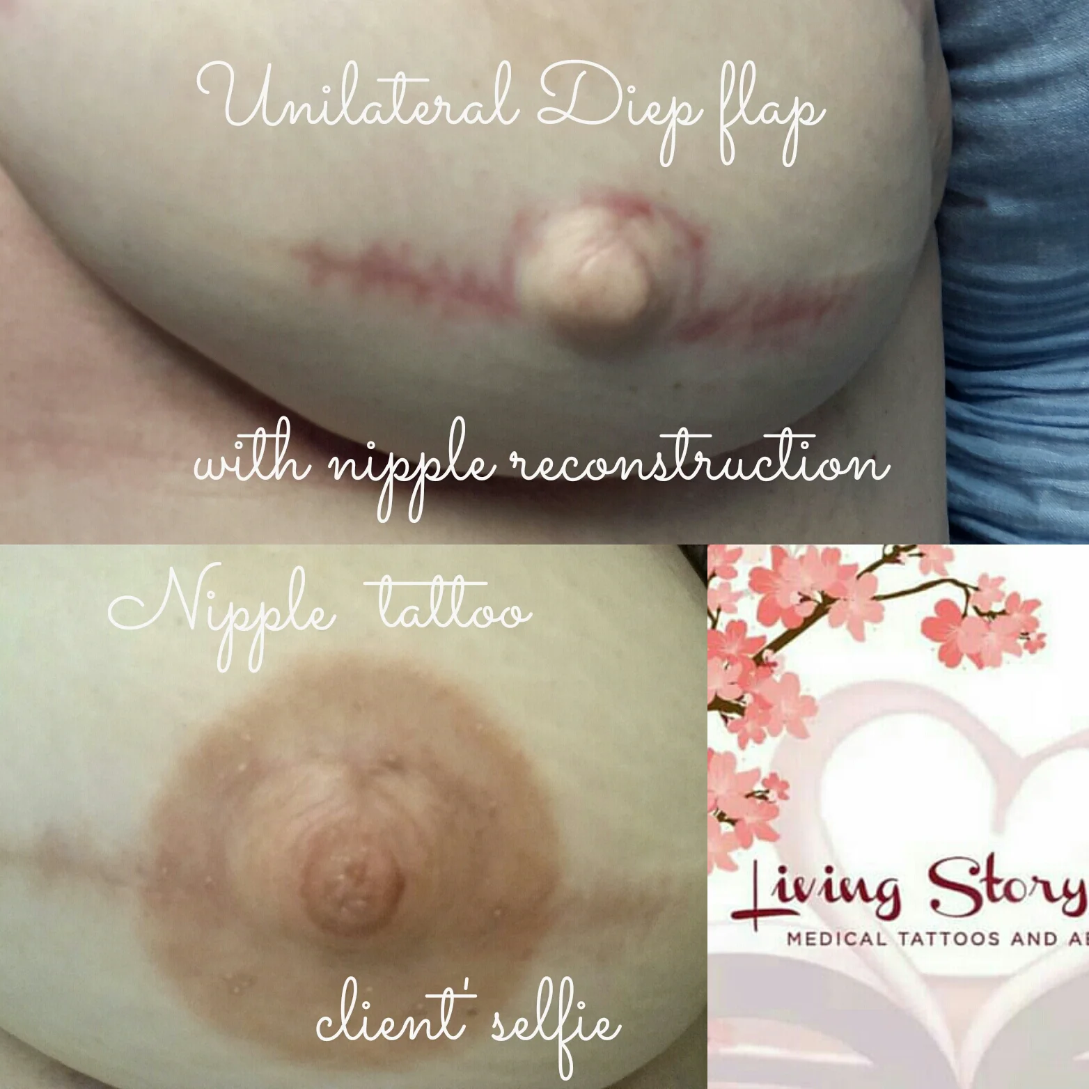 Unilateral tattoo