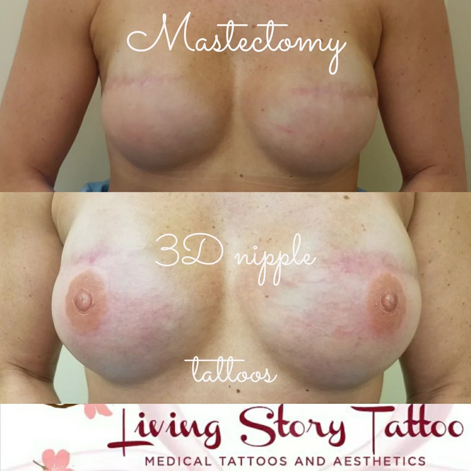 Bilateral implant 3D nipple