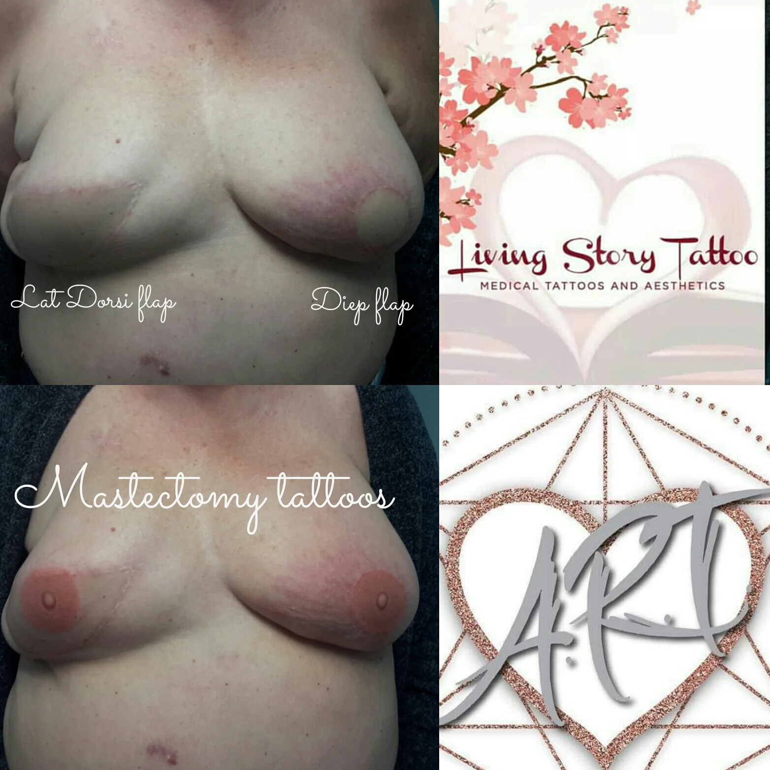 Bilateral 3D nipple tattoos