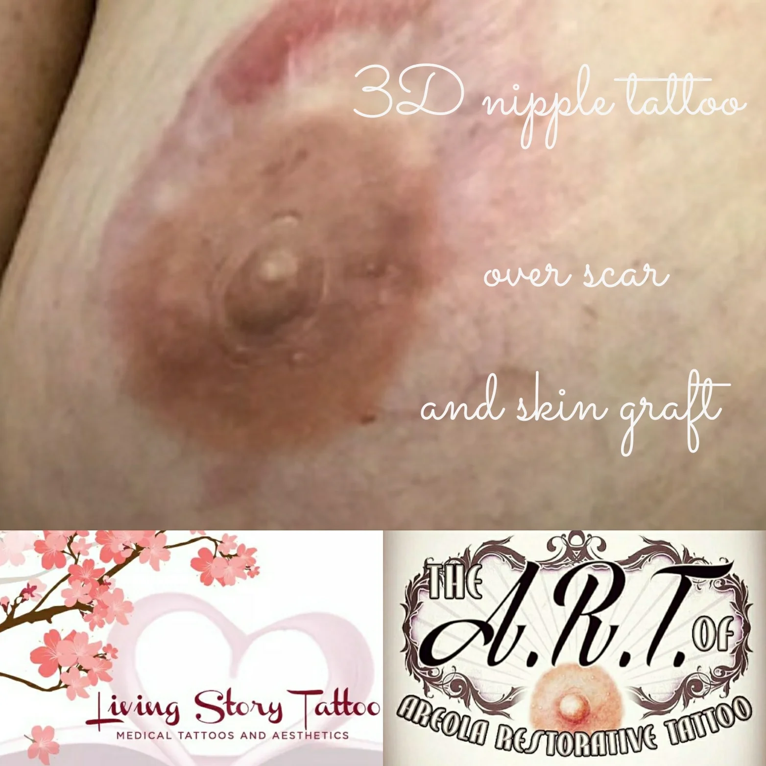 Unilateral 3D nipple HEALED