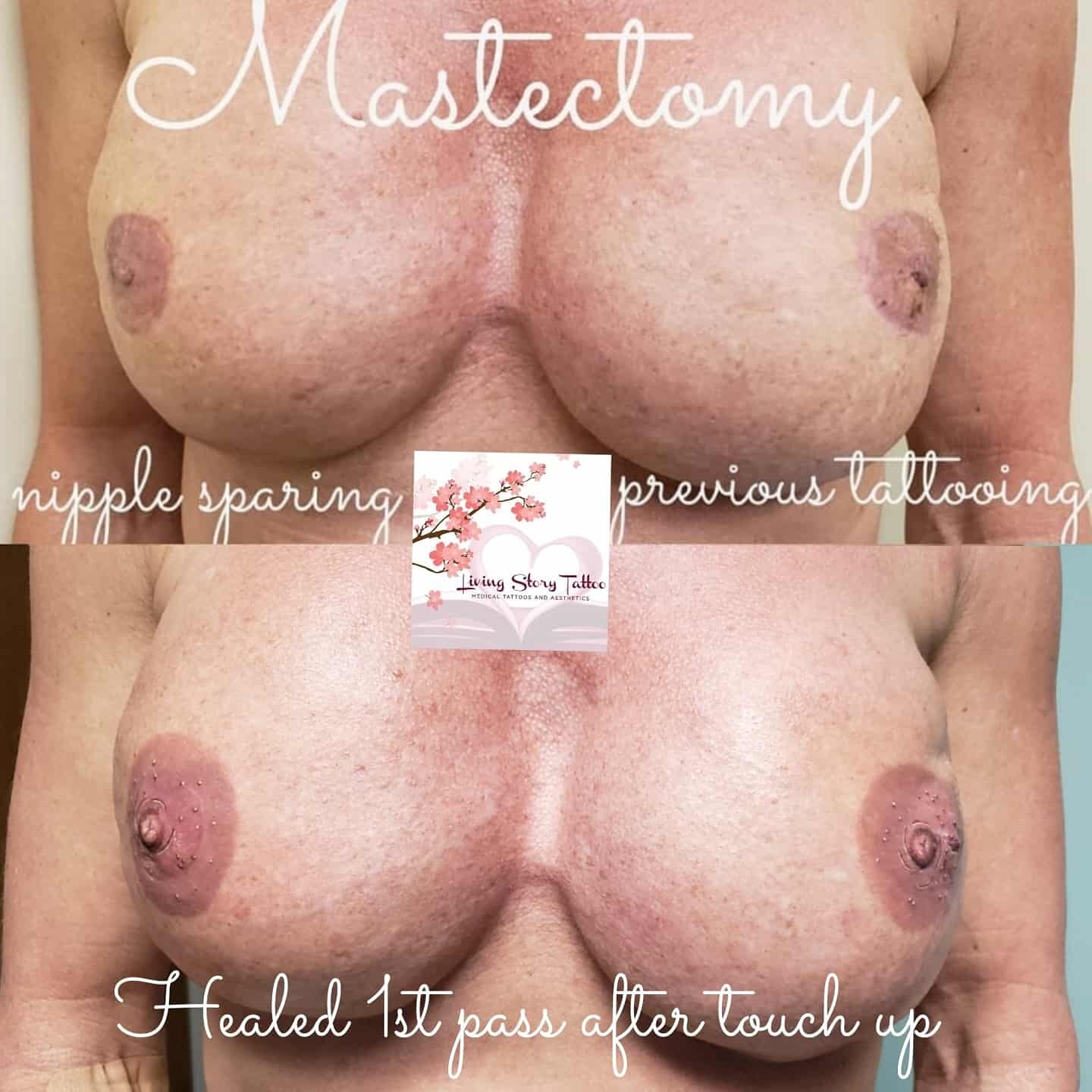 Bilateral corrective nipple sparing 