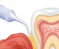  02. ARESTIN® microspheres are placed into infected pockets using a special plastic applicator. 