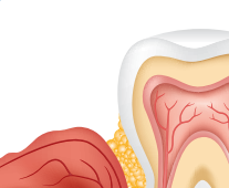  03. The antibiotic is released over time, helping to reduce bacteria as your gums heal.