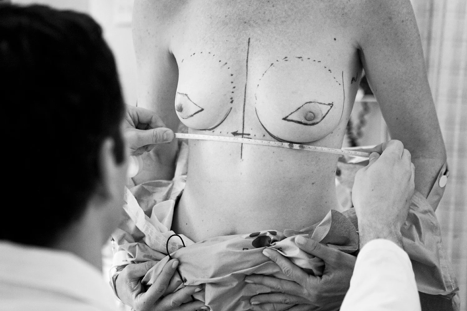"On the morning of my surgery, my plastic surgeon marks the areas of my breasts that will undergo reconstructive plastic surgery immediately following my bi-lateral mastectomy." Meredith Gray