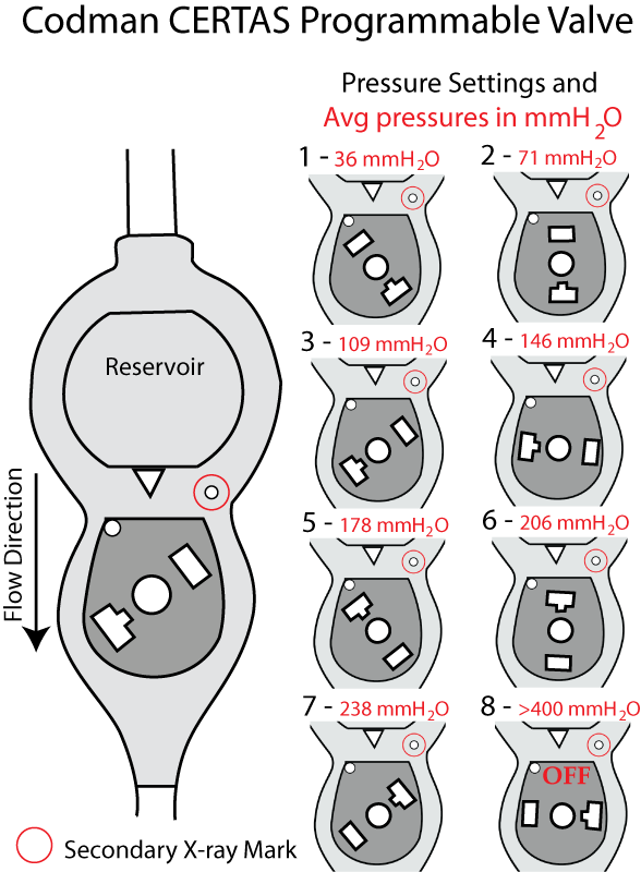 VP SHUNT SETTING PICTURES Ajay RAAVI