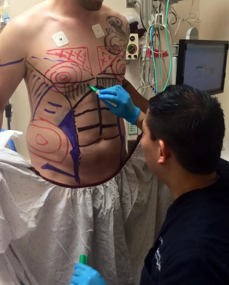 Dr. De La Cruz marking the patient for a 4D VASER Hi-definition Liposculpture. Each color represents the level and depth of liposuction involved.