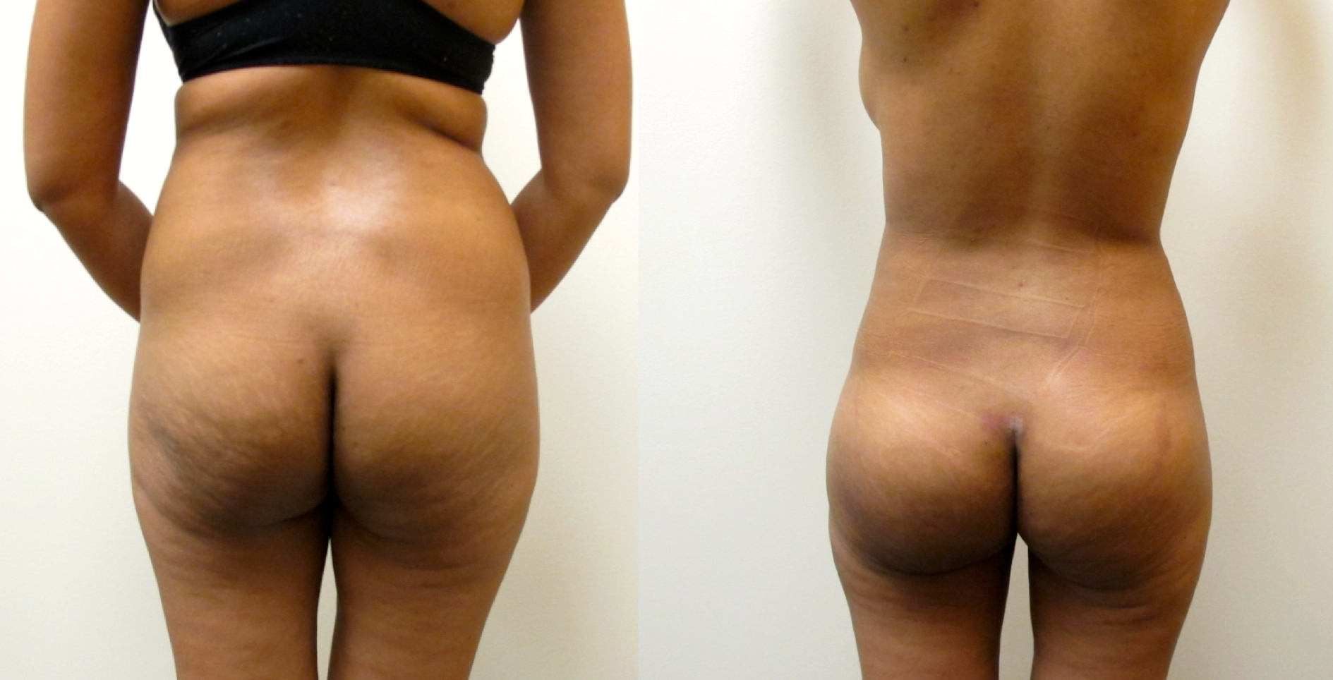 Figure1: Before & After Photos of 4 D VASER Hi-Definition Liposuction with Brazilian Butt Lift (6 DAYS after Surgery.) Procedure performed by Dr. Emmanuel De La Cruz in Houston, TX.