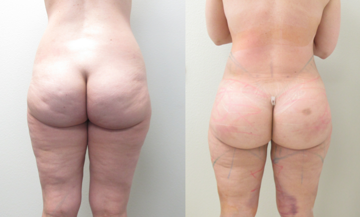 Figure 2: Before & After photos of Brazilian Butt Lift (24 HOURS after Surgery.) Procedure performed by Dr. Emmanuel De La Cruz in Houston, TX.