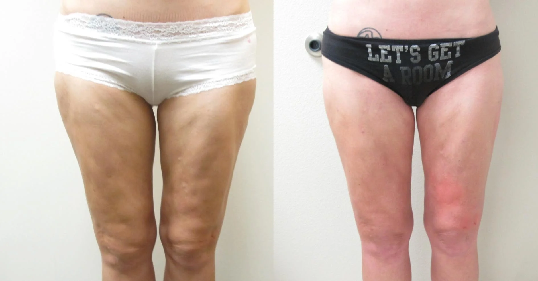 Before & After Correction of Skin Contour Irregularities (Frontal View). Patient previously had traditional liposuction from another plastic surgeon and she developed skin contour irregularity. Dr. De La Cruz performed the VASER liposuction of the thighs with fat transfer to correct the contour irregularity.