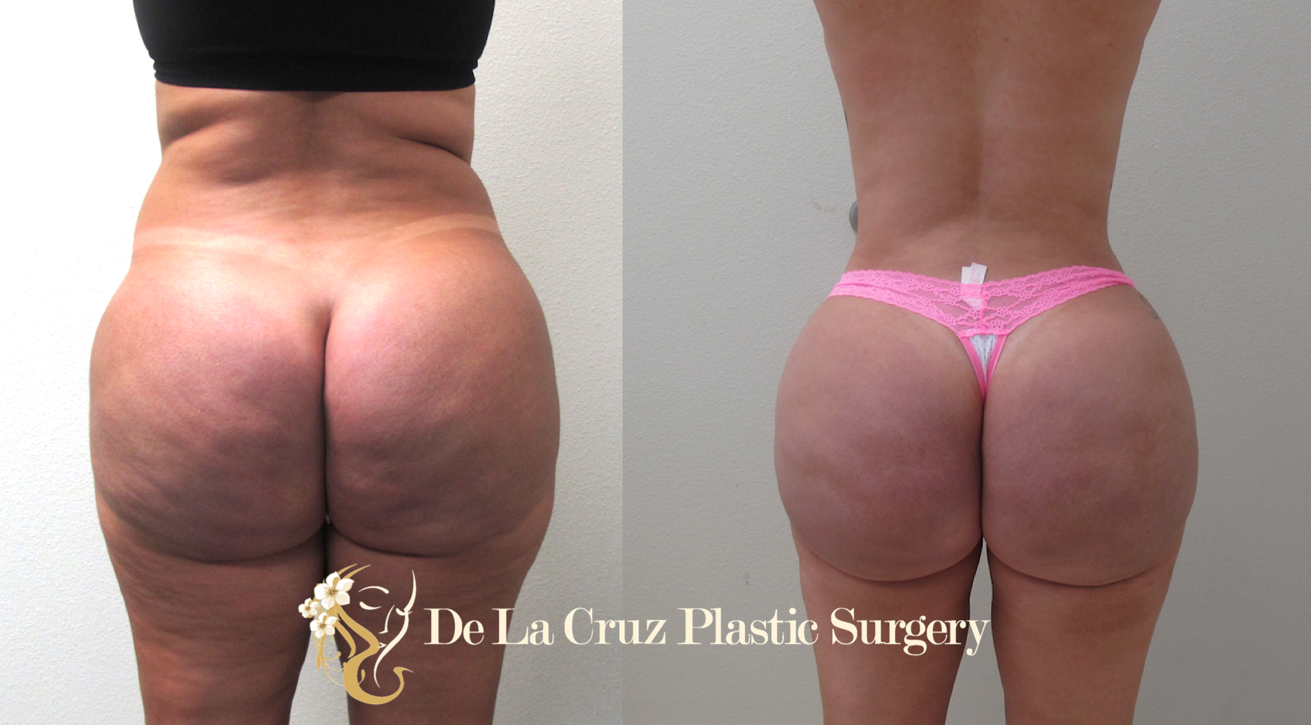 Figure 2: Hydrogel/Biopolymer removal from the buttocks using the VASER Liposuction with fat transfer to the buttocks to correct the resulting deformity from removal of the biopolymer. Patient had resolution of a chronic buttock pain after surgery.