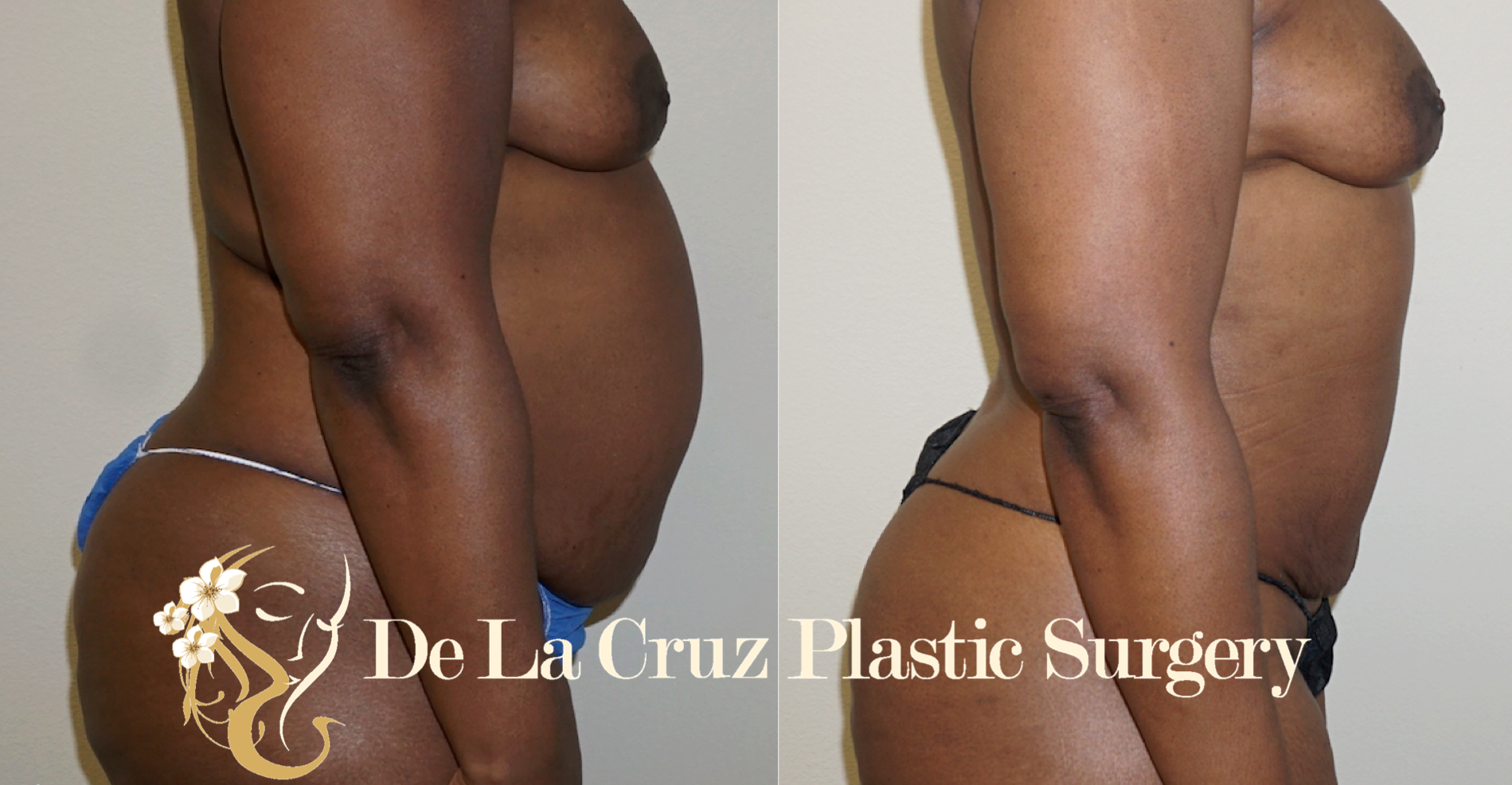 Figure 1: Before and After Photos (3 months after surgery) after VASER Hi-Definition Liposuction performed by Dr. De La Cruz. Note that there was significant skin retraction after surgery.