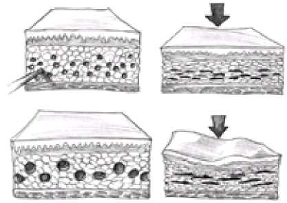 Using a smaller cannulae produces less skin contour irregularity as compared to a larger liposuction cannulae.