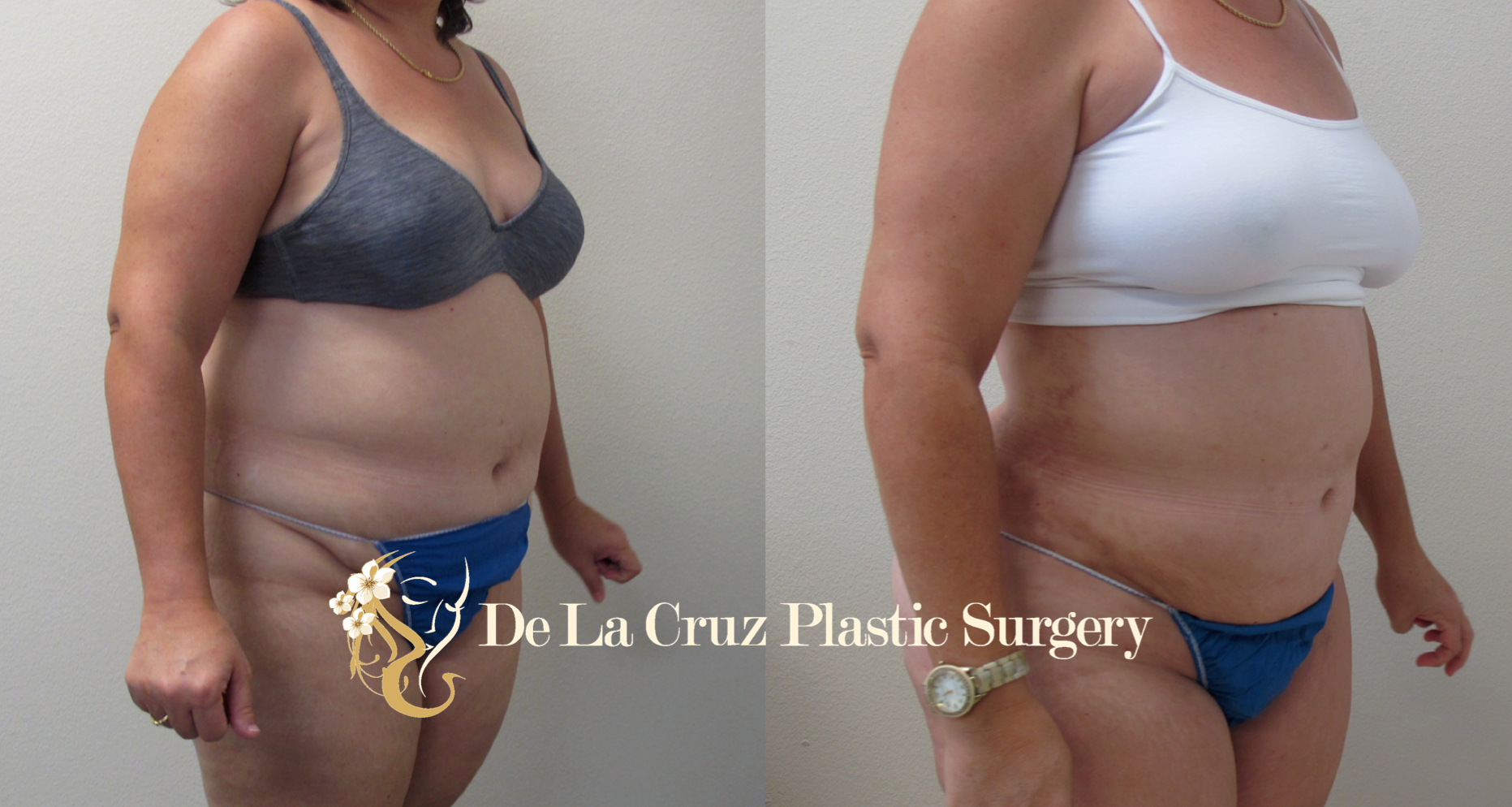 VASER Liposuction (Before and After 6 months of Surgery) performed by Dr. Emmanuel De La Cruz