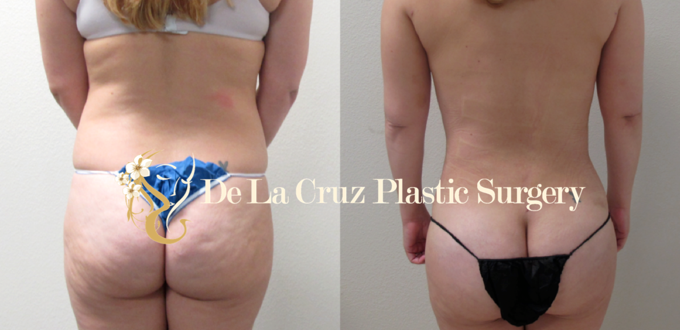 How to Combine Liposuction With a BBL for a Perfect Summer Body - Aria  Cosmetic Surgery