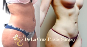 Before & After Photos (8 weeks after surgery) of VASER Hi-Definition Liposuction of the abdomen, arms, thighs, back with Brazilian Butt Lif t performed by Emmanuel De La Cruz MD, PLLC.