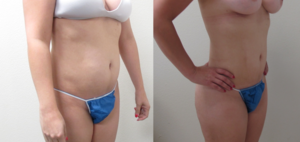 Before & After Photos of VASER Liposuction of the Abdomen and flanks performed by Emmanuel De La Cruz MD, PLLC.