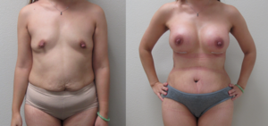 Before & After Photos of Abdominoplasty & Breast Augmentation (Mommy Make Over) performed by Emmanuel De La Cruz MD, PLLC