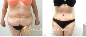 Before & After Photos of Abdominoplasty with VASER Liposuction of the flanks performed by Emmanuel De La Cruz MD, PLLC