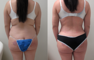 Before & After Photos of VASER Hi-Definition Liposuction of the abdomen, back with Biopolymer removal from the buttock and fat transfer to the buttock performed by Dr. Emmanuel De La Cruz 