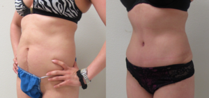 Before & After Photos of Abdominoplasty ( Tummy Tuck ) with VASER Liposuction of the flanks performed by plastic surgeon Emmanuel De La Cruz MD