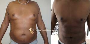 Before & After Photos of 4D VASER Hi-Definition Liposuction of the Abdomen/flanks/back with correction of gynecomastia performed by Emmanuel De La Cruz MD, PLLC (Houston Plastic Surgeon)