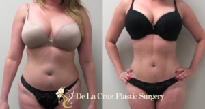Before & After Photos of 4D VASER Hi-Definition Liposuction of a female patient performed by Emmanuel De La Cruz MD, PLLC