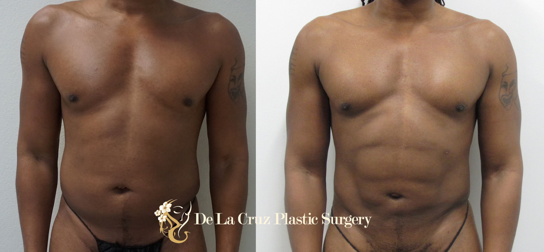 Before & After Photos of 4D VASER High-Definition Liposuction of the arms, abdomen/flanks/back (6 weeks after surgery) performed by Houston Plastic Surgeon Emmanuel De La Cruz MD, PLLC