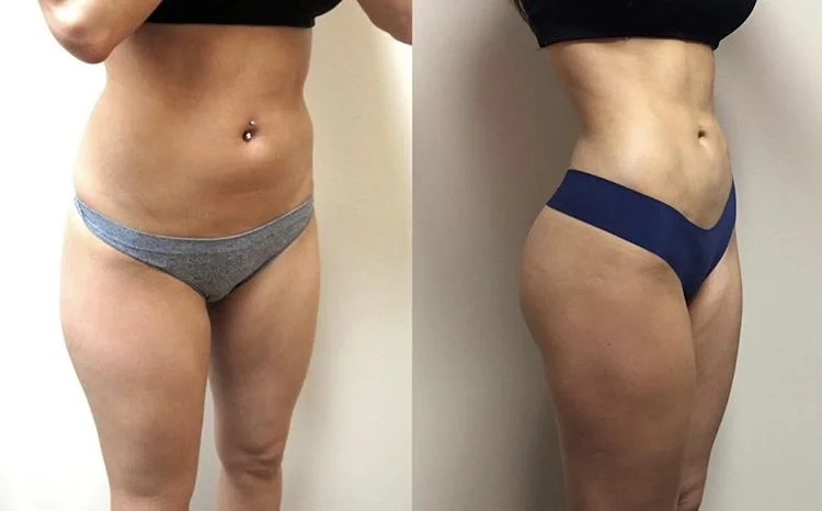  VASER liposuction with fat transfer to the buttocks performed by Dr. De La Cruz. 