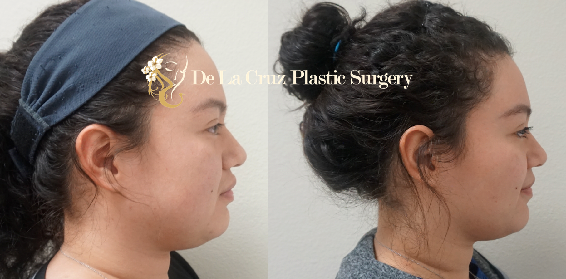 Before and After Photos of Buccal Fat Removal (Bichectomia) 8 weeks after surgery performed by Dr, Emmanuel De La Cruz in Houston, Texas.