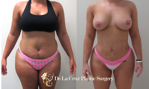  4D High-Definition VASER Liposuction performed by Dr. Emmanuel De La Cruz.