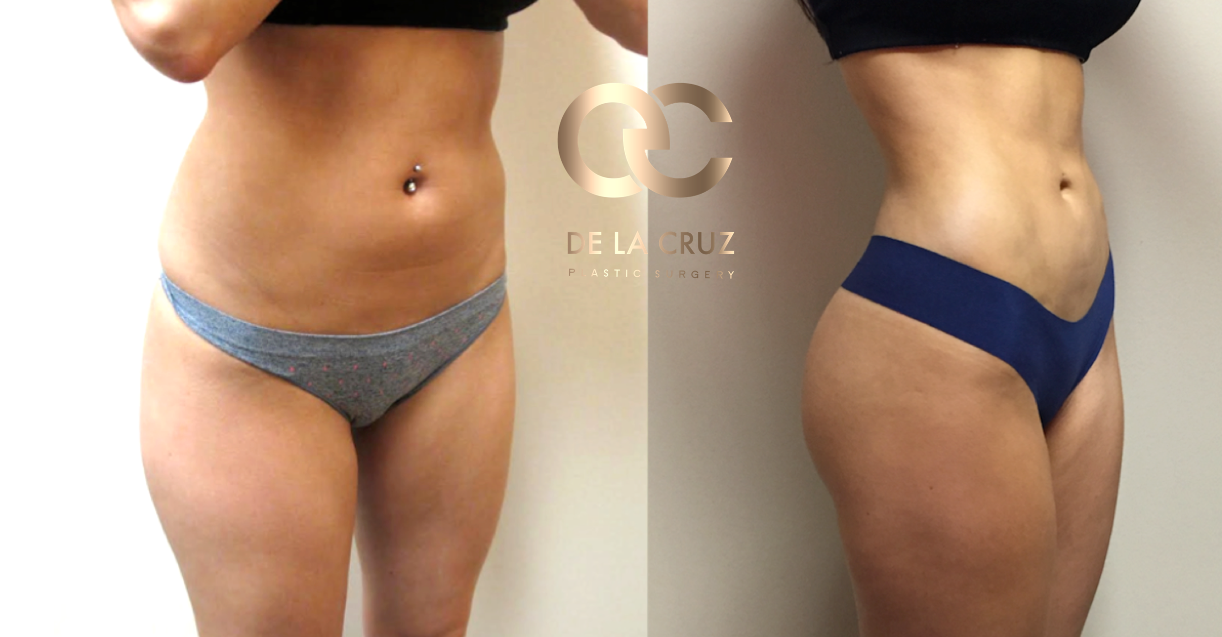 Figure 4: Before & After Photos of 4 D VASER High-Definition Liposculpture with Fat Transfer to the Buttock (1 year after Surgery.) Surgery was performed by Dr. Emmanuel De La Cruz, a Houston Plastic Surgeon.