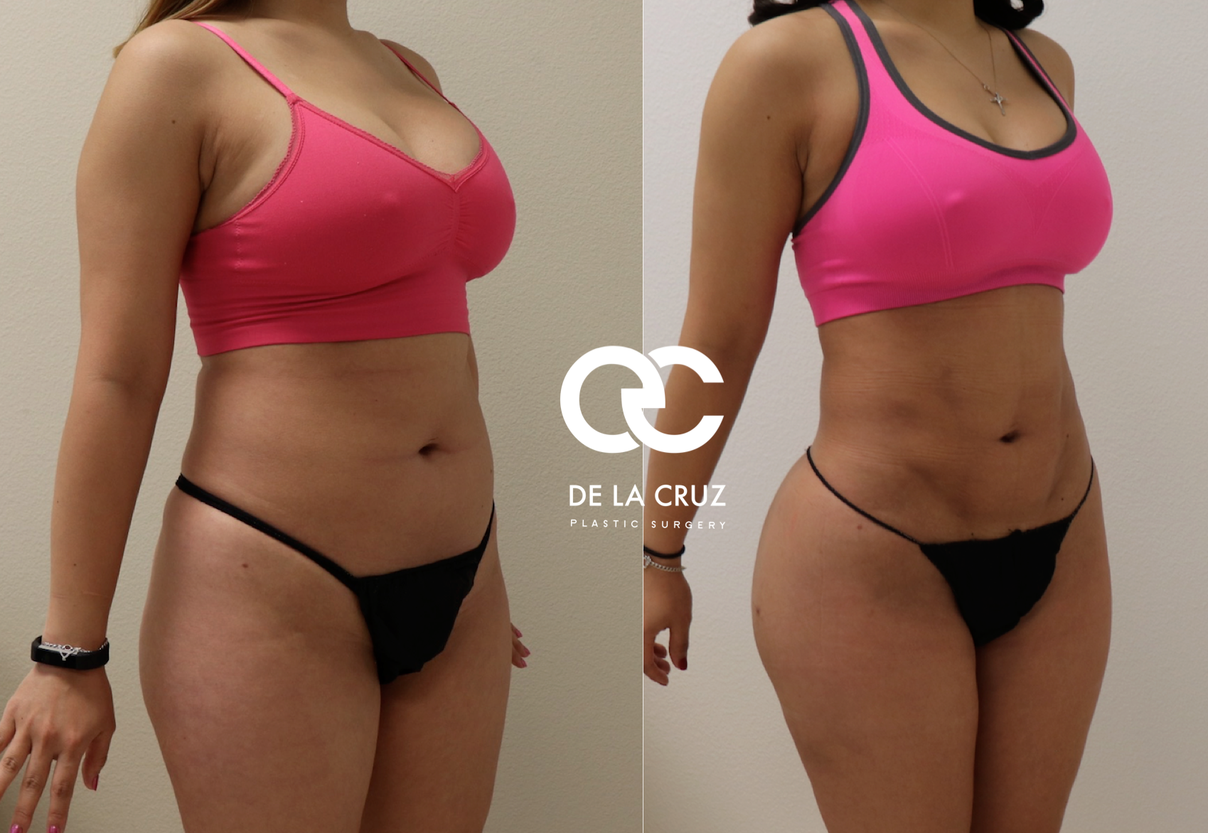 Before and after liposuction (female) .