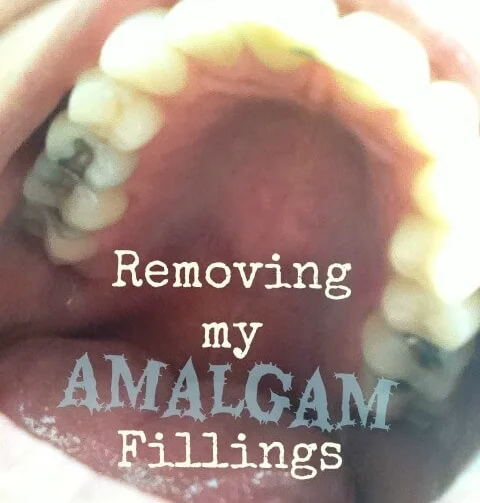 Removing-my-Amalgam-Fillings.jpg