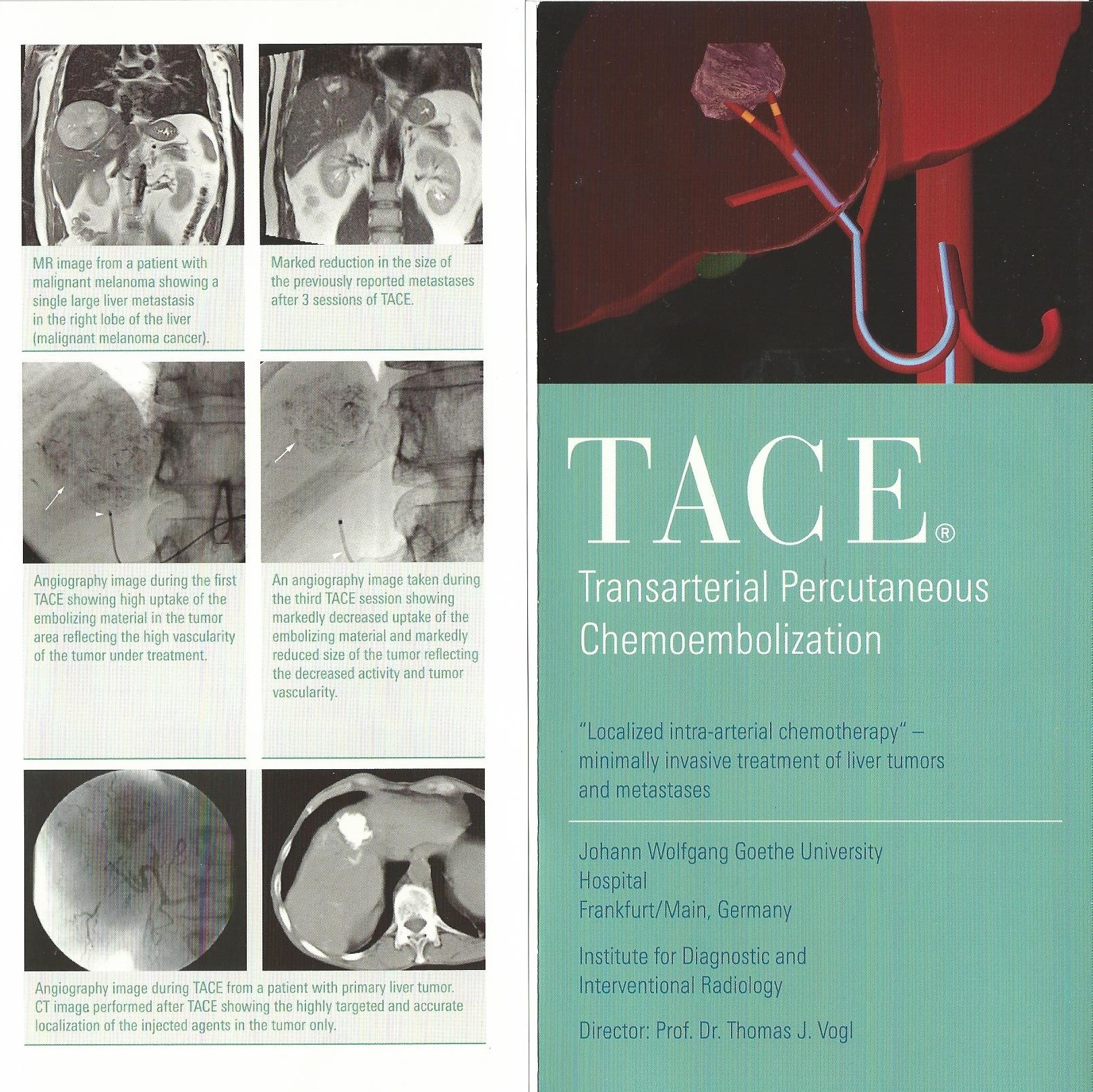 MOre about TACE