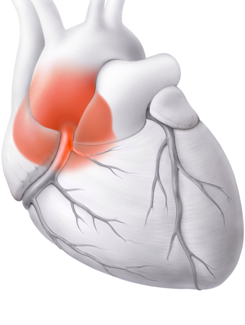 2-2 bioprotesi della stenosi aortica.jpg