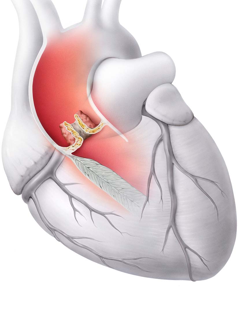 Sténose de la valve aortique (rétrécissement de la valve cardiaque)