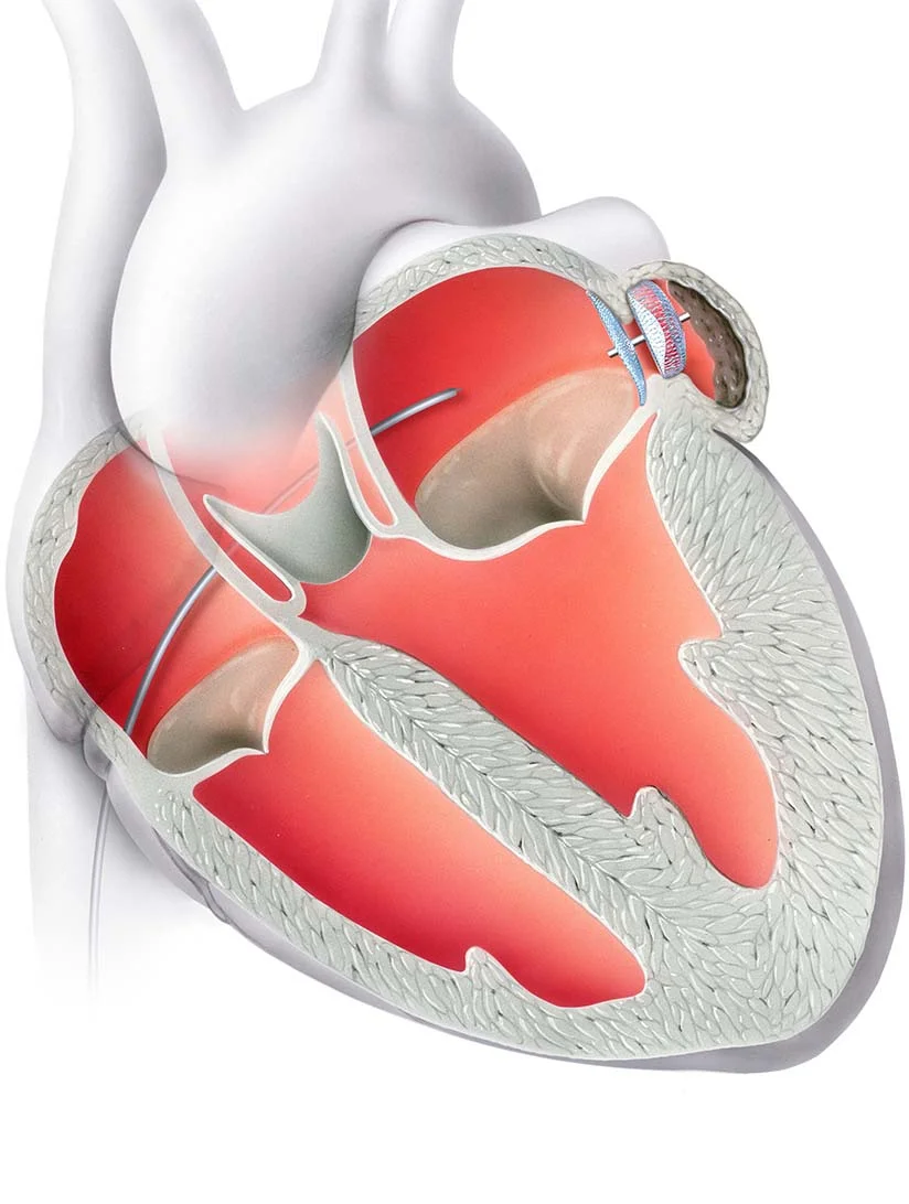 Angeborenen und erworbenen Herzfehler