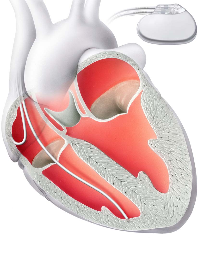 2-2-Aortenstenose-Bioprothese.jpg