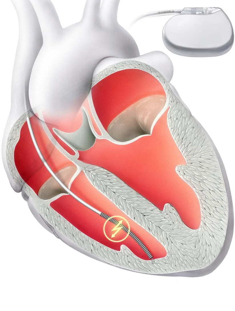 HerzDefibrillator Implantation (ICD)