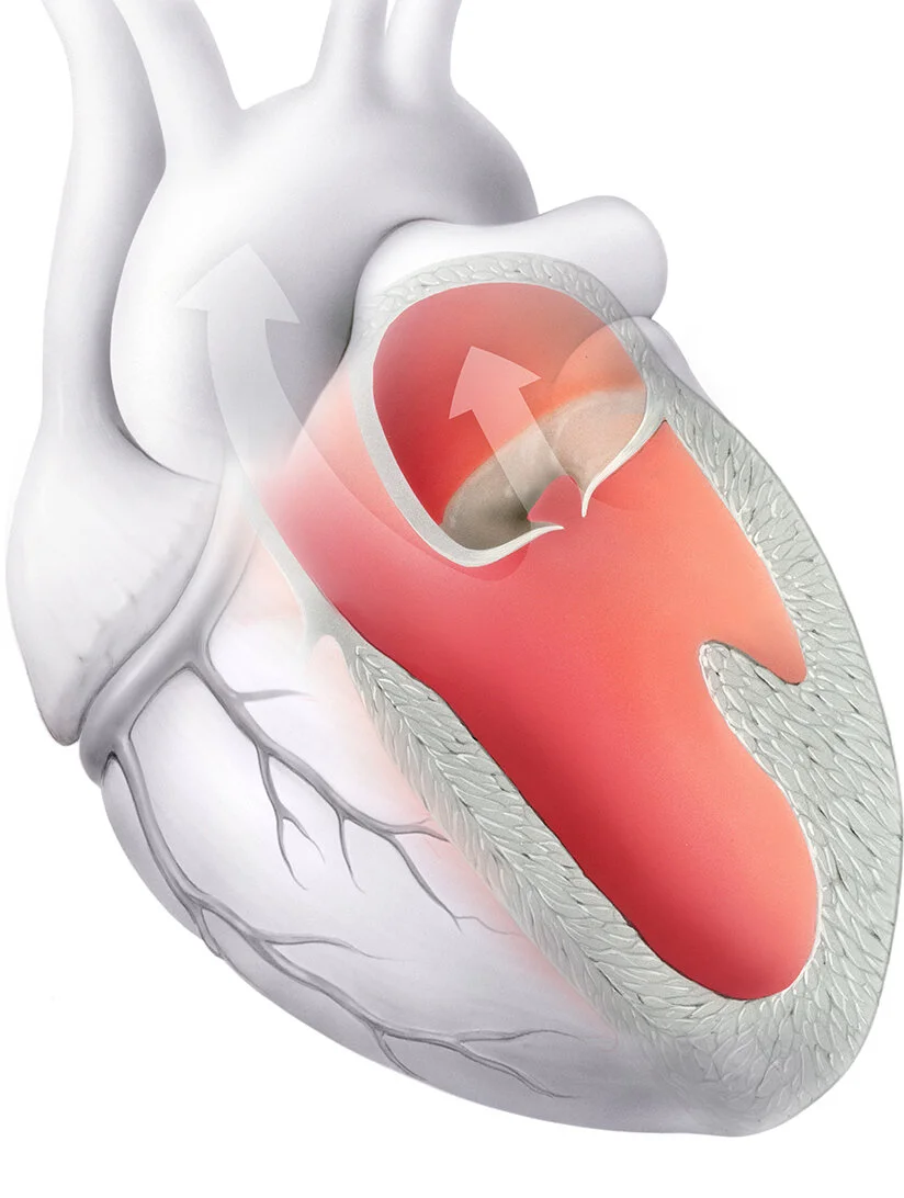Herzschwäche (Insuffizienz)
