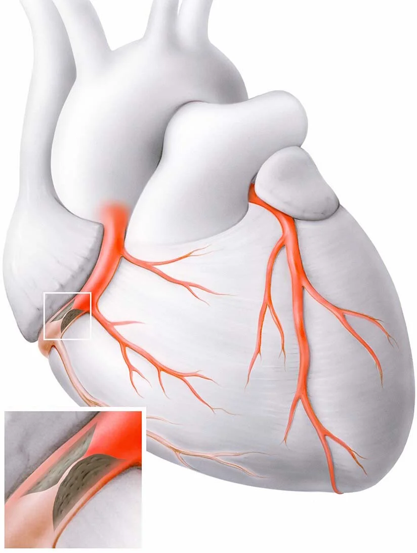 Koronare Herzerkrankung