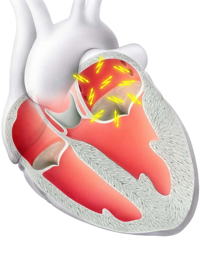 Herzrhythmus-Störungen
