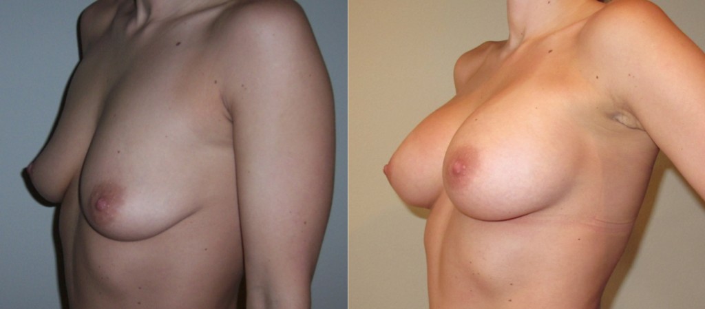 Houston-Breast-Augmentation-The-Woodlands-Breast-Augmentation-by-Dr.-De-La-Cruz-1024x449.jpg