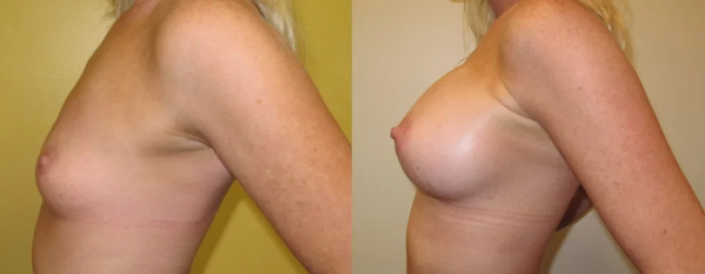 breast-augmentation-in-The-Woodlands.jpg