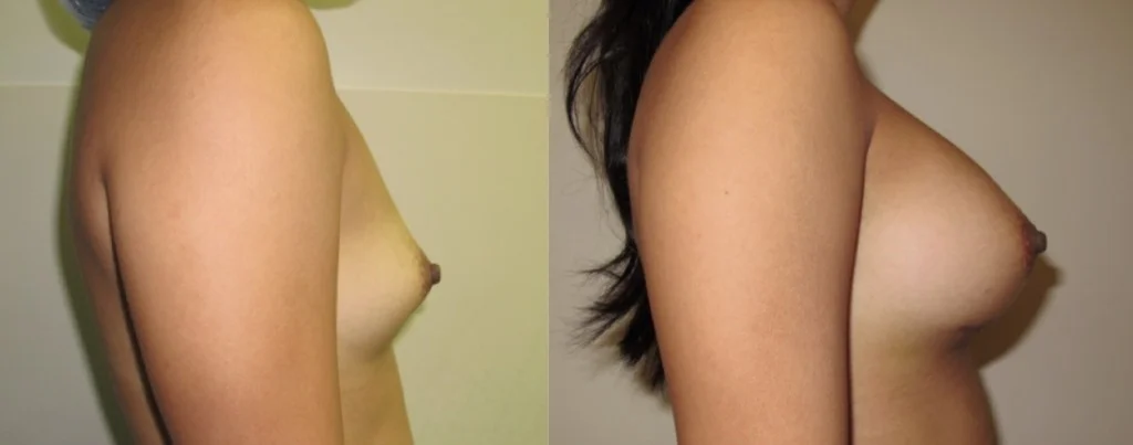 The-Woodlands-and-Houston-Breast-Augmentation-Silicone-Gel-Breast-Implants-by-Dr-De-La-Cruz-1024x403.jpg