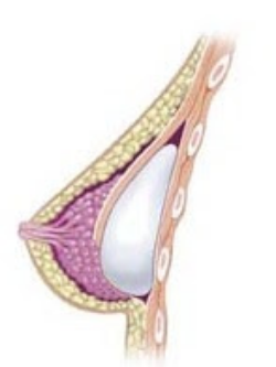 Subpectoral_breast_implants.jpg