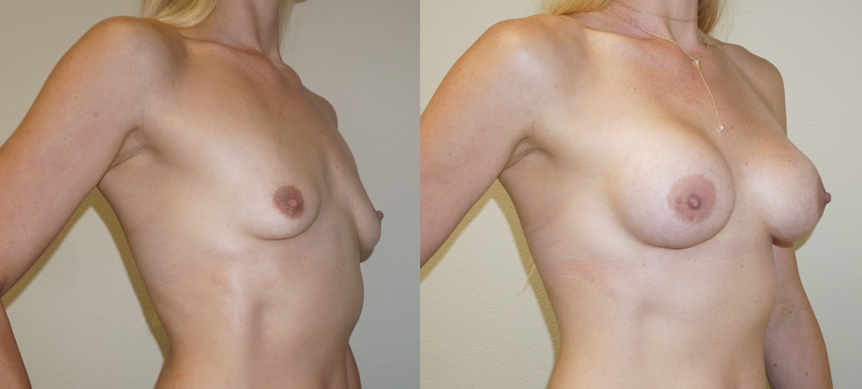 best plastic surgeon houston breast augmentation.png